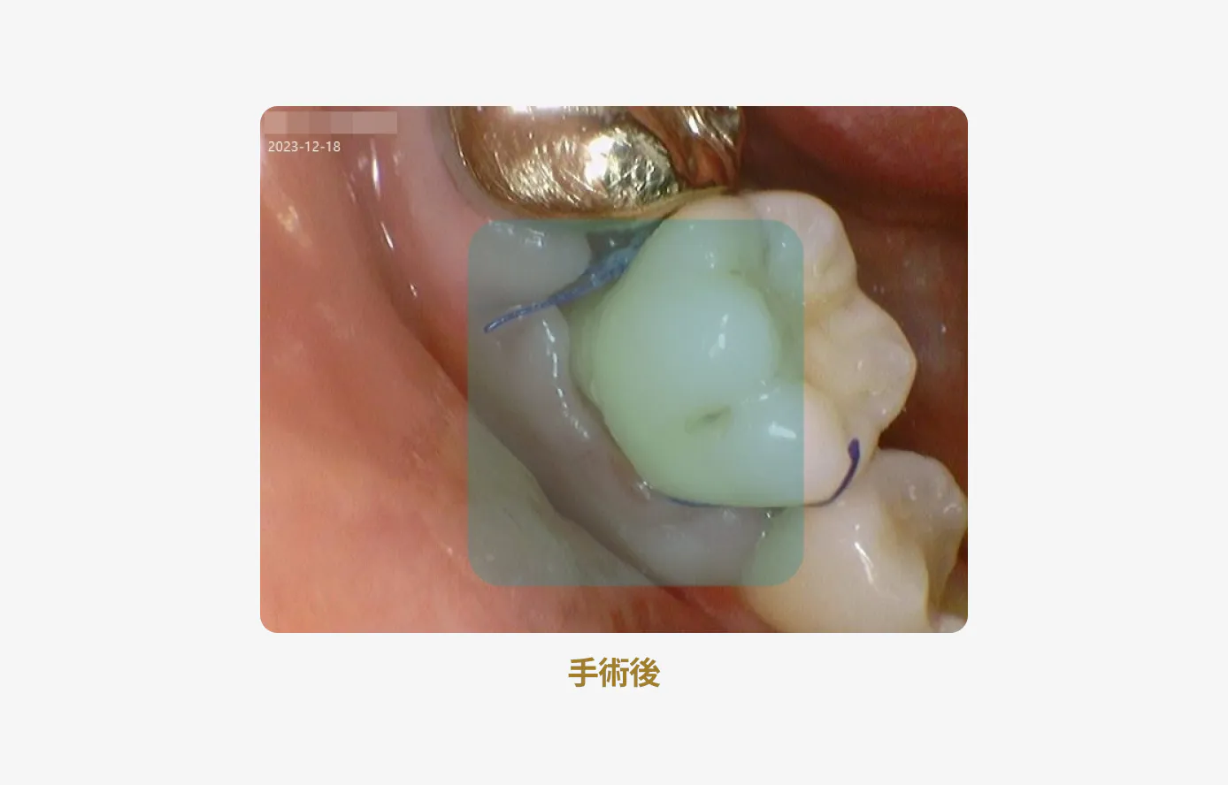 手術後