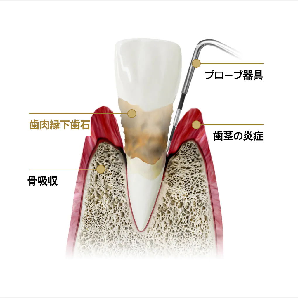 プローブ器具 | 歯茎の炎症 | 歯肉縁下歯石 | 骨吸収