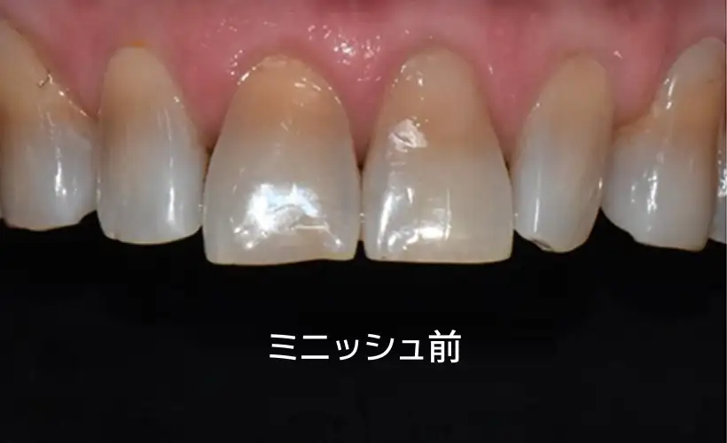 ミニッシュによる歯の保存治療
