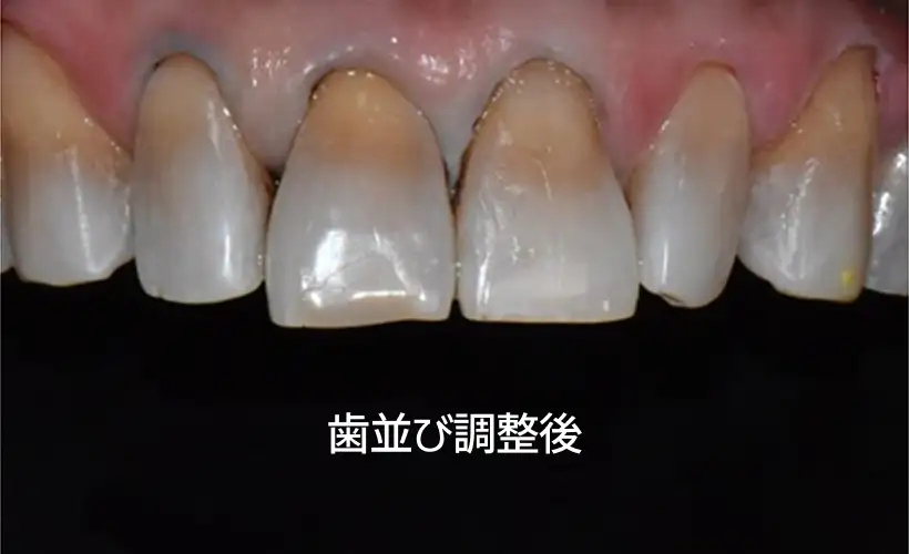 ミニッシュによる歯の保存治療
