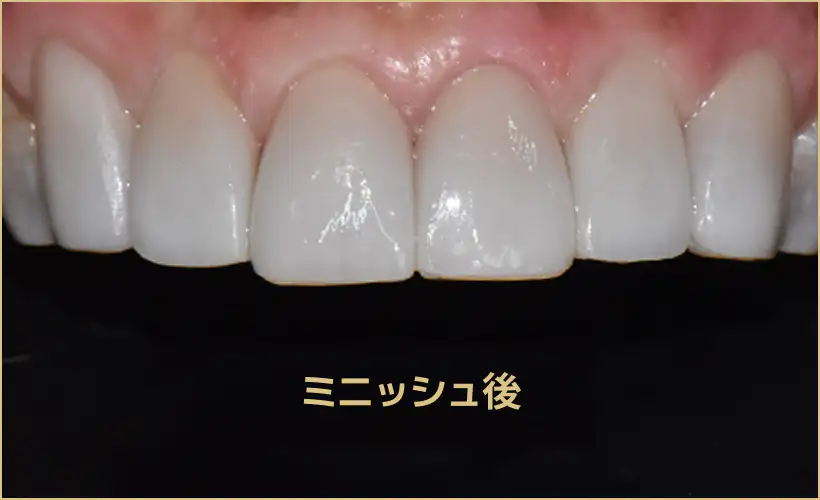 ミニッシュによる歯の保存治療