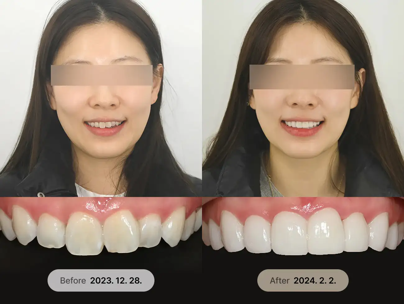 べニアキューブ Veneer 非ポアフターケース 1