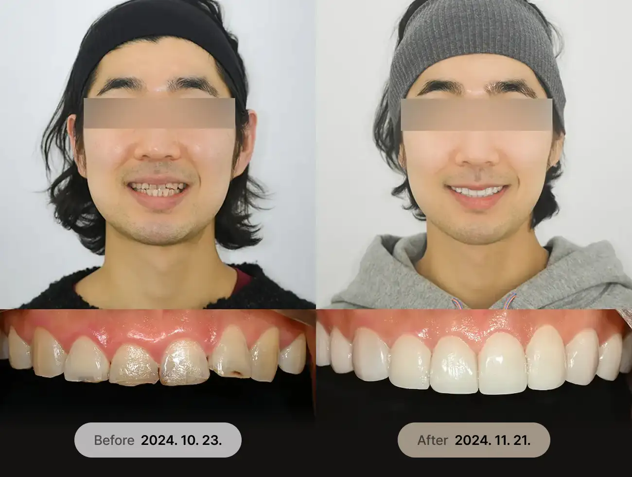べニアキューブ Veneer 非ポアフターケース 2