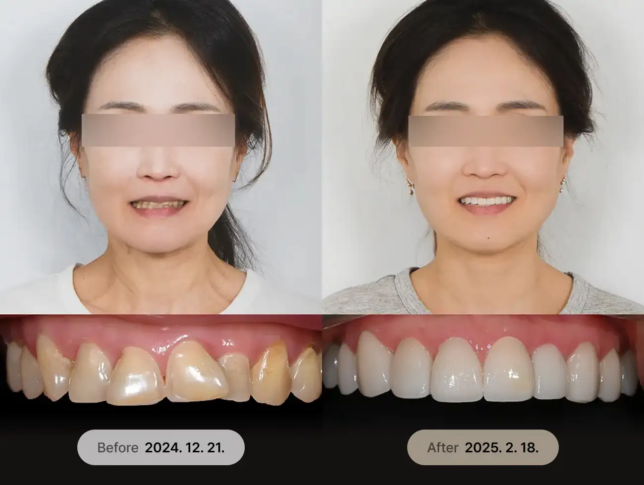 べニアキューブ Veneer 非ポアフターケース 3