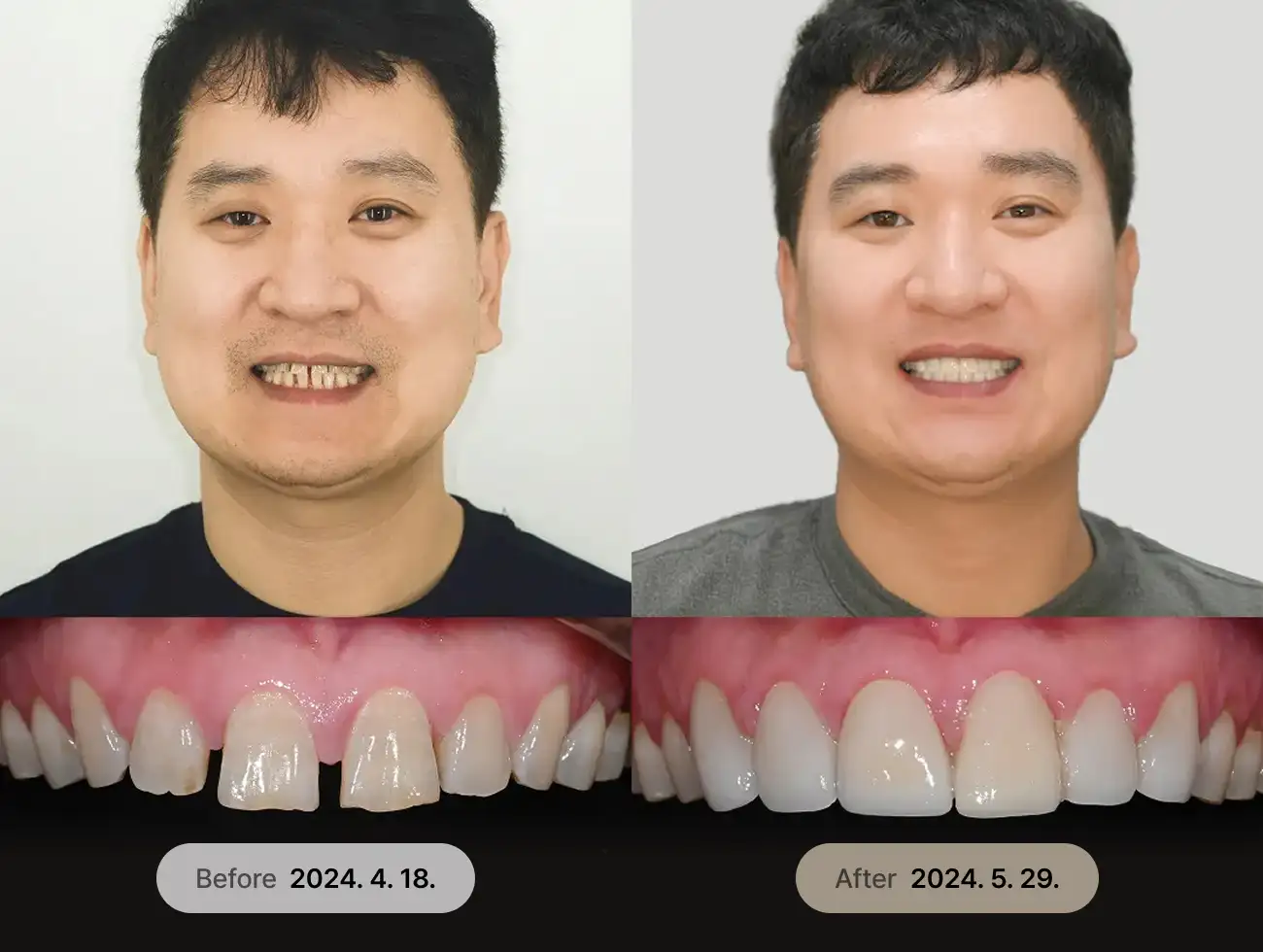 べニアキューブ Veneer 非ポアフターケース 4