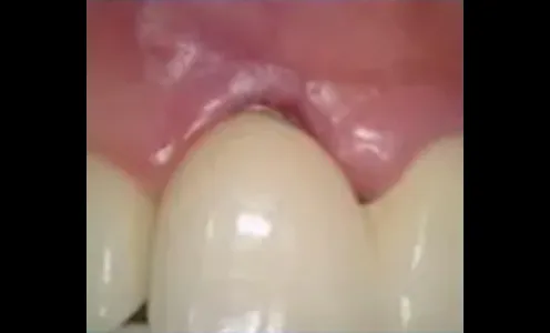3wks after PDRN injection (4th)