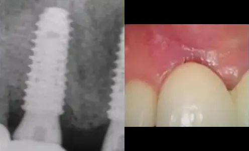 2M after PDRN injection (5th)