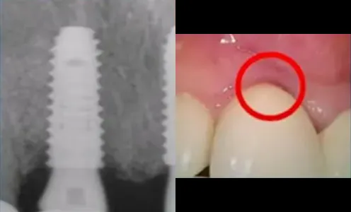 3M after PDRN injection