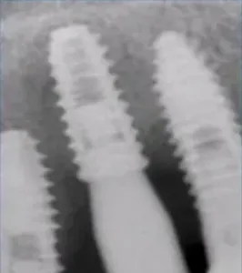 2Ms after PDRN injection(4th)