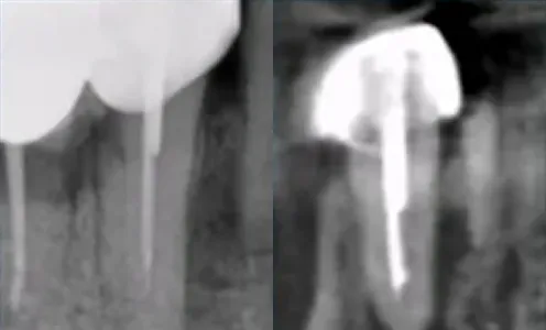 5Ms after PDRN injection(CT exam)