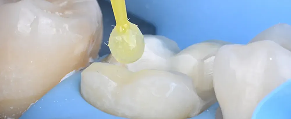 長持ちするインレーのためのテクニック | 即時象牙質シーリング Immediate Dentin Sealing, IDS
