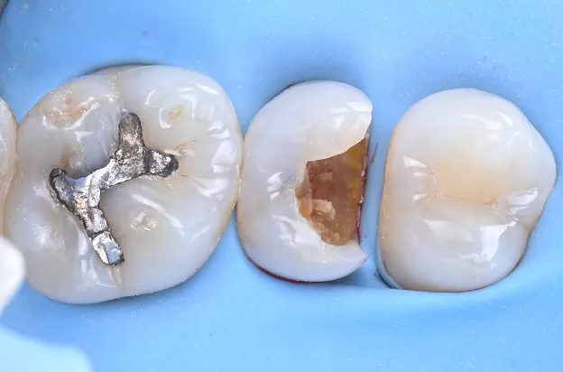 レジンコア修復 Resin Core Build-up