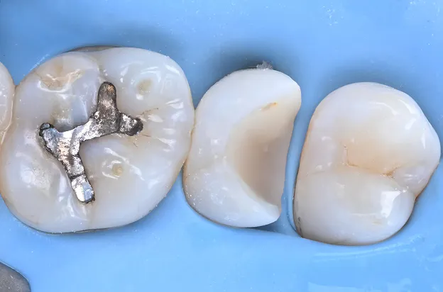 レジンコア修復 Resin Core Build-up