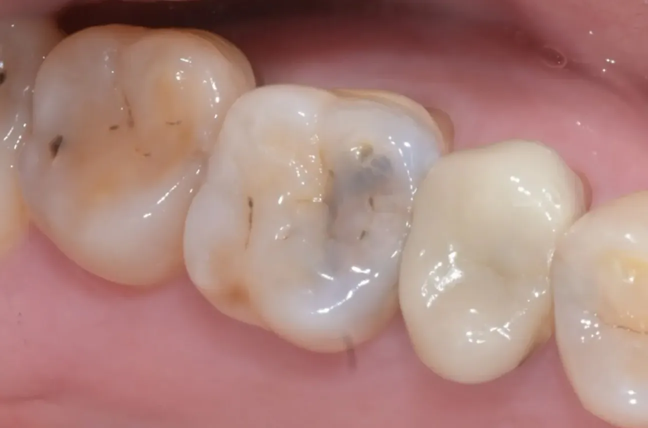 虫歯がある歯 (う蝕症 Caries)