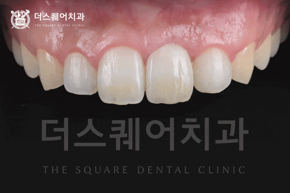 앞니 임플란트 Anterior Implant
