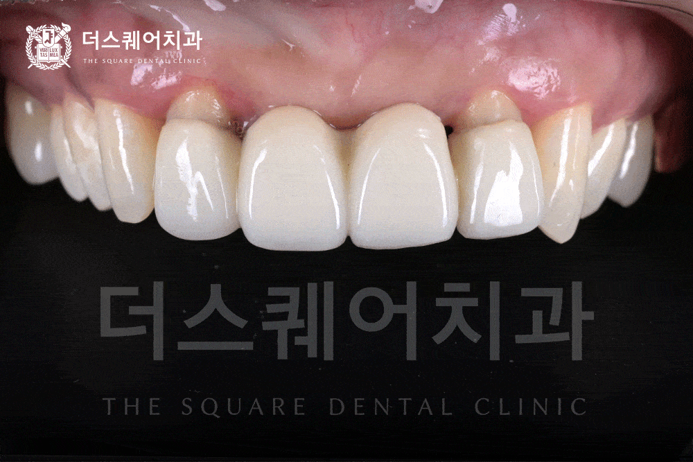 앞니 임플란트 Anterior Implant 첫 인상을 결정하는 앞니