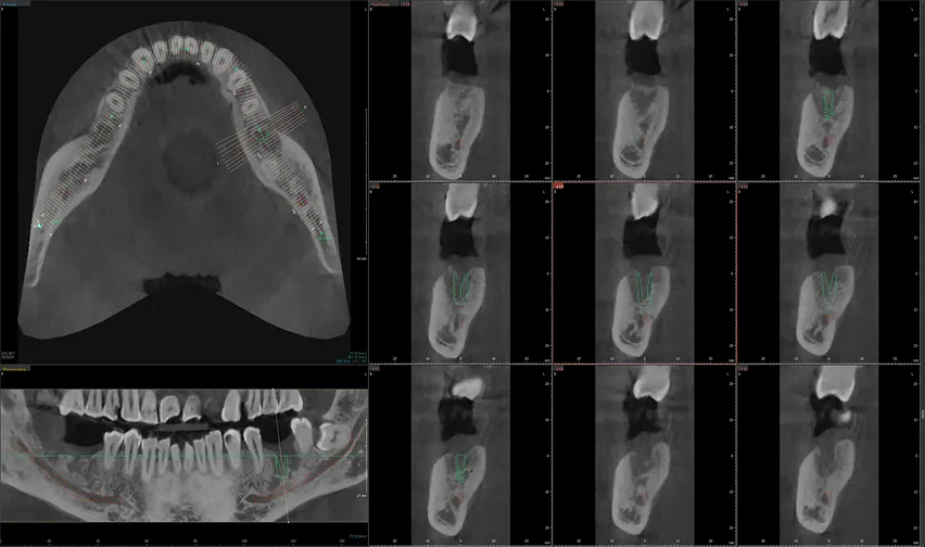 Guided Surgery