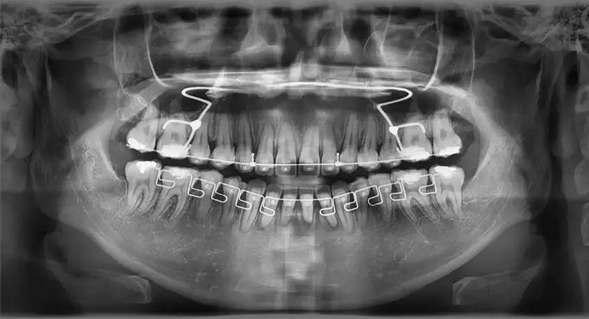 骨の成長を利用した歯茎退縮のない歯体移動 | MARPE