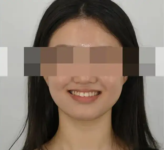本当の歯の矯正は顔を一緒に見なければなりません。