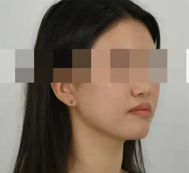 本当の歯の矯正は顔を一緒に見なければなりません。