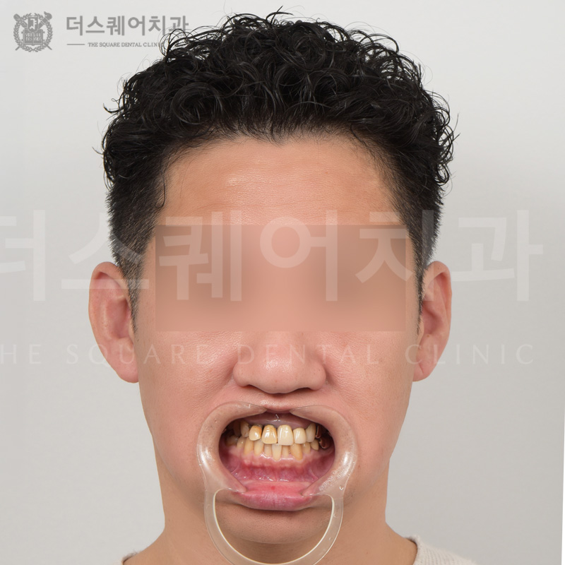 틀어진 치아 및 기존 보철 재치료를 위한 세라믹 크라운