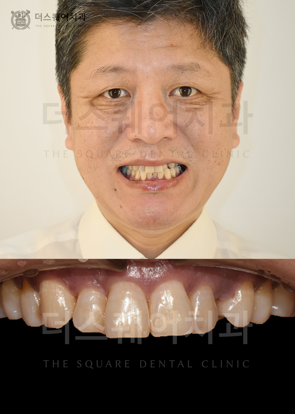 상하악 미니쉬로 노화된 치아의 배열과 색상을 해결한 케이스
