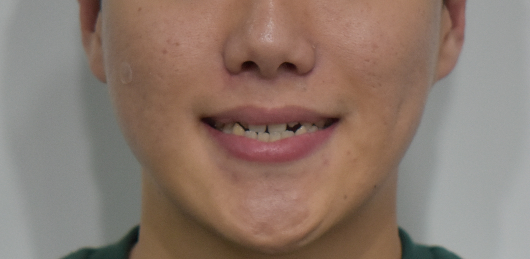 부정교합 및 덧니 브라켓 교정으로 가지런한 배열 해소