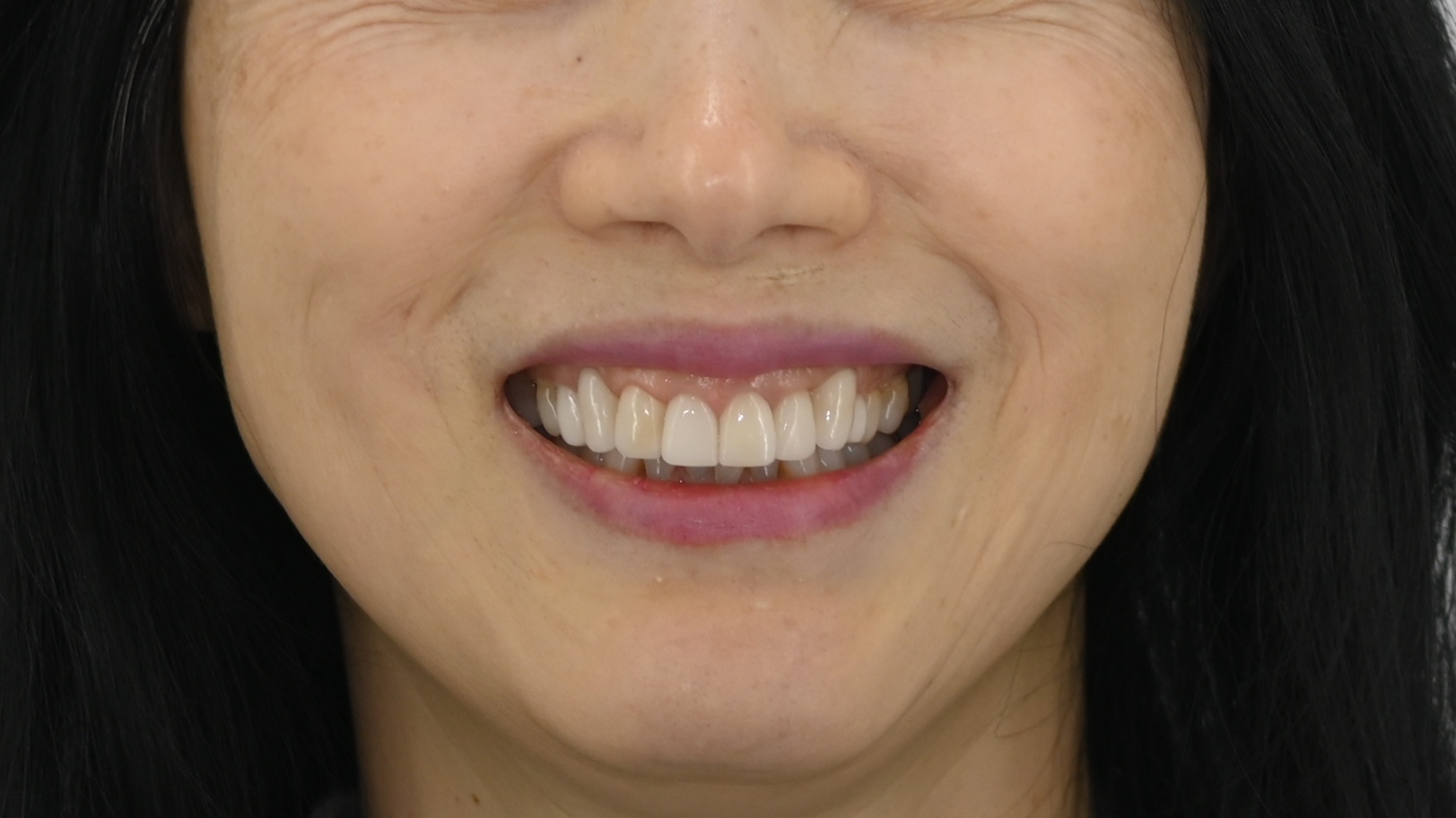 <br />
<b>Warning</b>:  Undefined variable $ba_title in <b>/home/thesquaredc.co.kr/jp/clinical-case/clinicalcase.php</b> on line <b>605</b><br />
