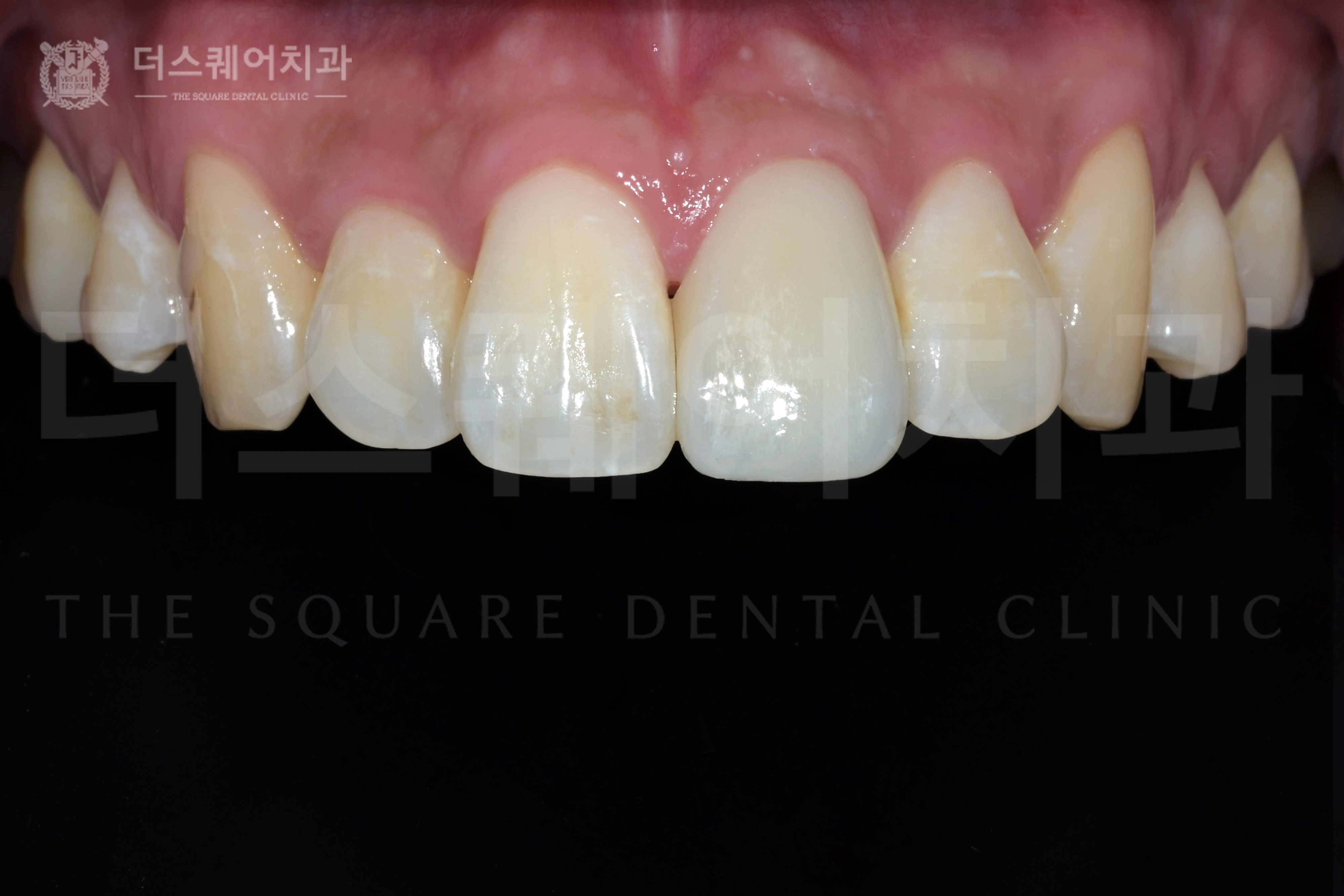 <br />
<b>Warning</b>:  Undefined variable $ba_title in <b>/home/thesquaredc.co.kr/jp/clinical-case/clinicalcase.php</b> on line <b>605</b><br />
