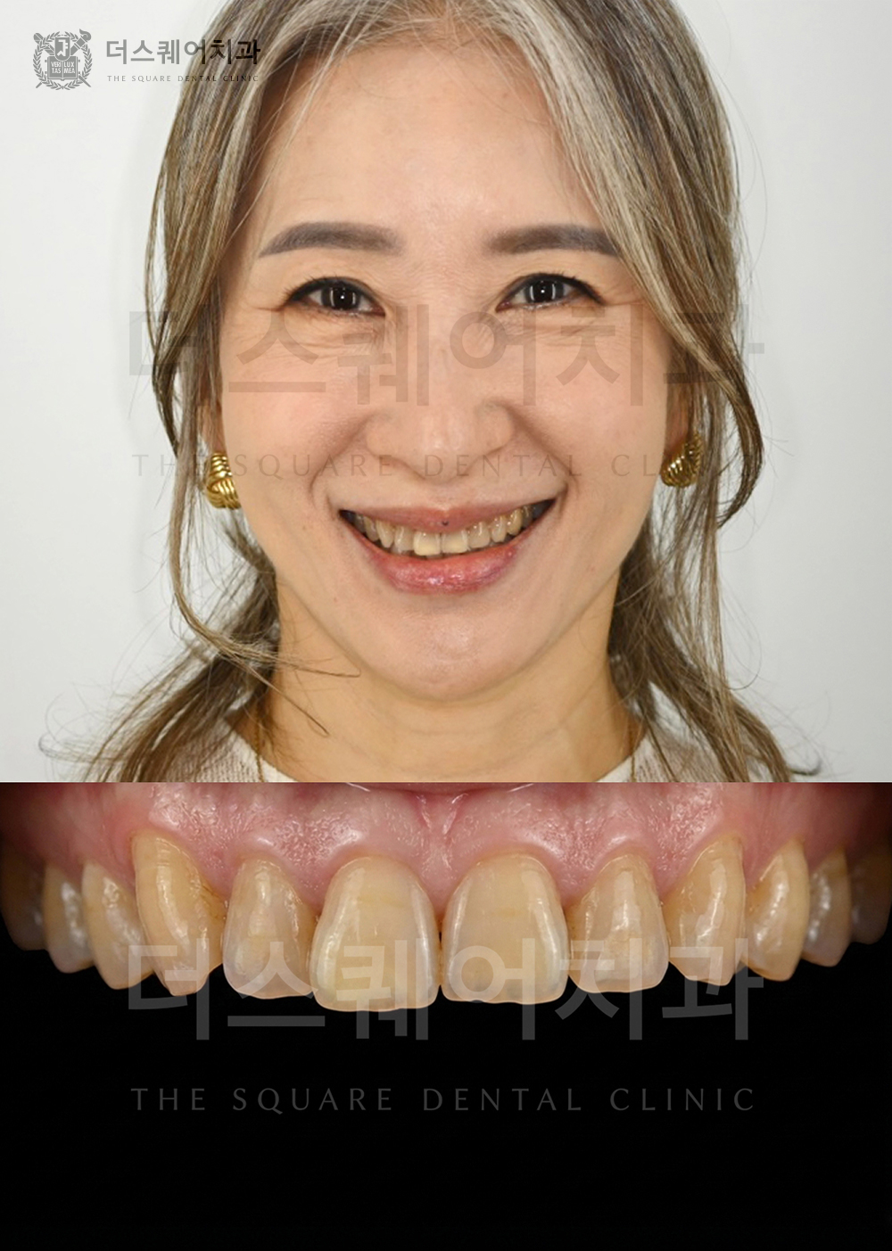 미니쉬로 치아노화를 해결한 케이스