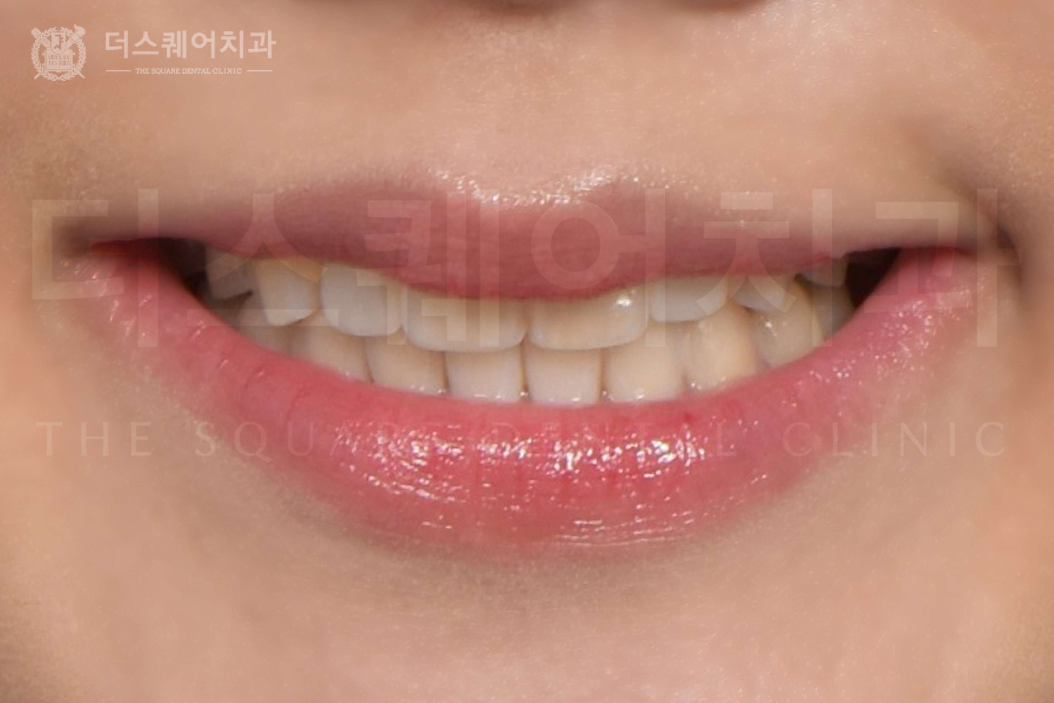 <br />
<b>Warning</b>:  Undefined variable $ba_title in <b>/home/thesquaredc.co.kr/jp/clinical-case/clinicalcase.php</b> on line <b>605</b><br />
