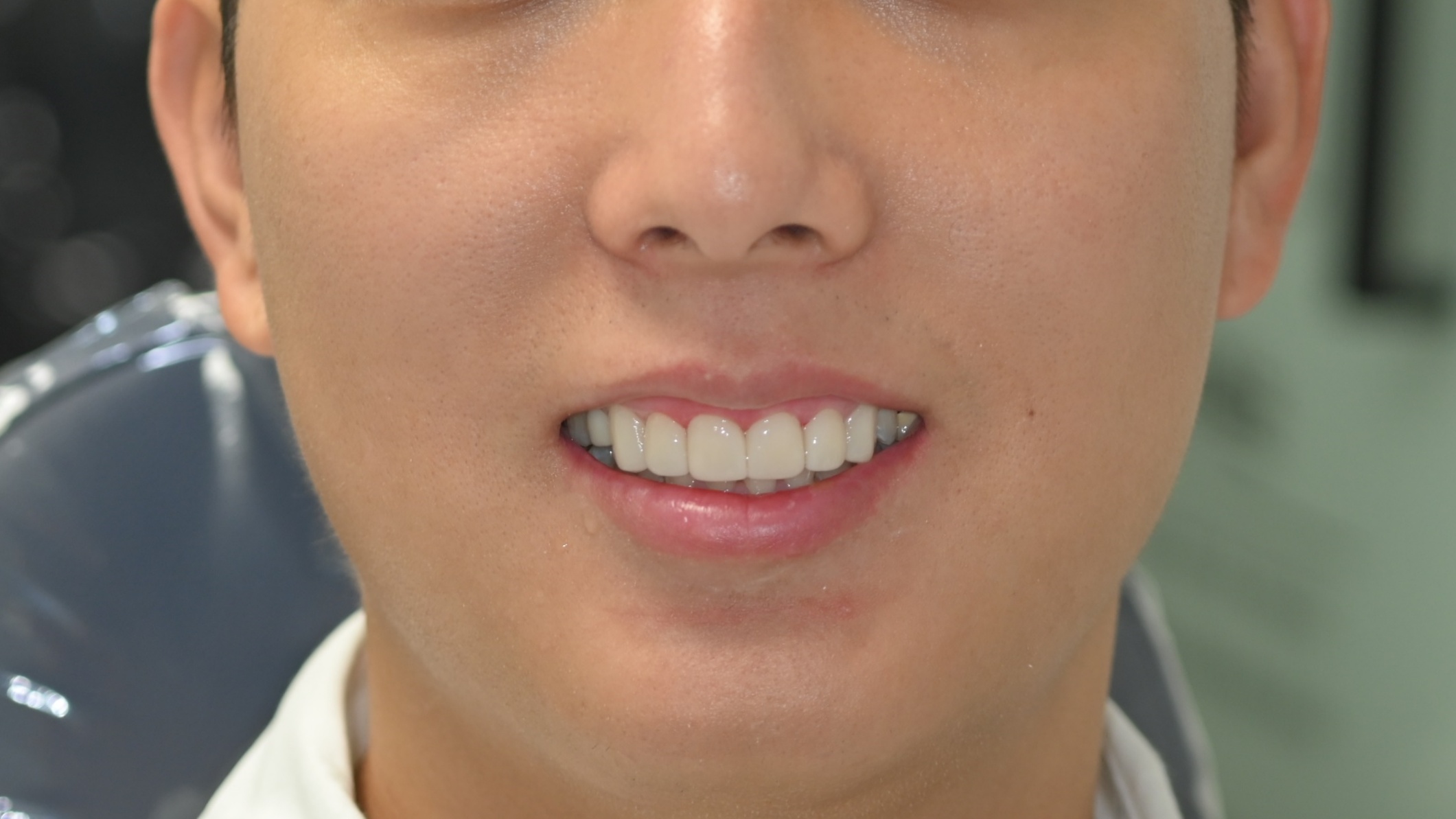 <br />
<b>Warning</b>:  Undefined variable $ba_title in <b>/home/thesquaredc.co.kr/jp/clinical-case/clinicalcase.php</b> on line <b>605</b><br />
