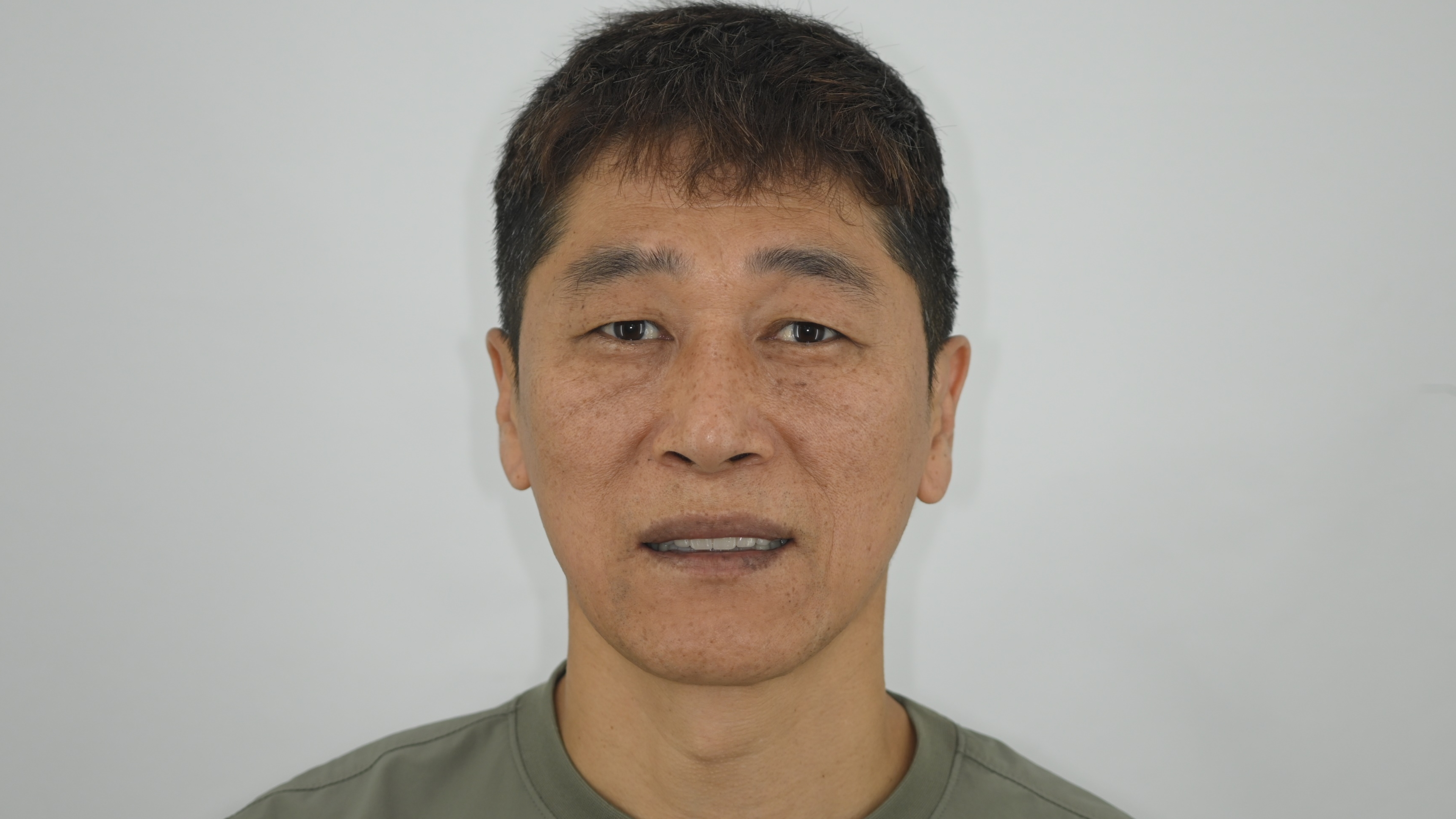 전체 임플란트를 통한 기능 및 얼굴 재건