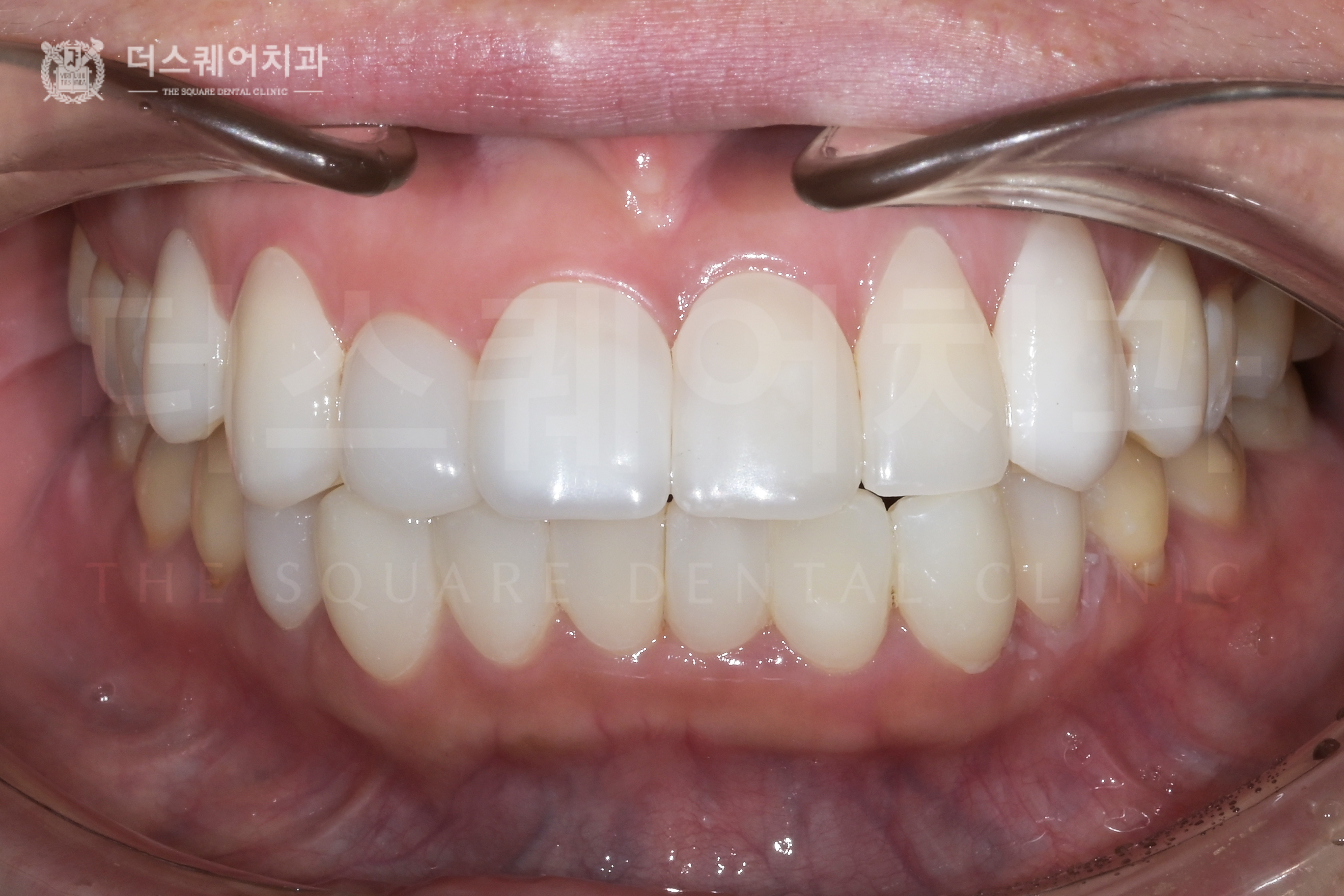<br />
<b>Warning</b>:  Undefined variable $ba_title in <b>/home/thesquaredc.co.kr/jp/clinical-case/clinicalcase.php</b> on line <b>605</b><br />
