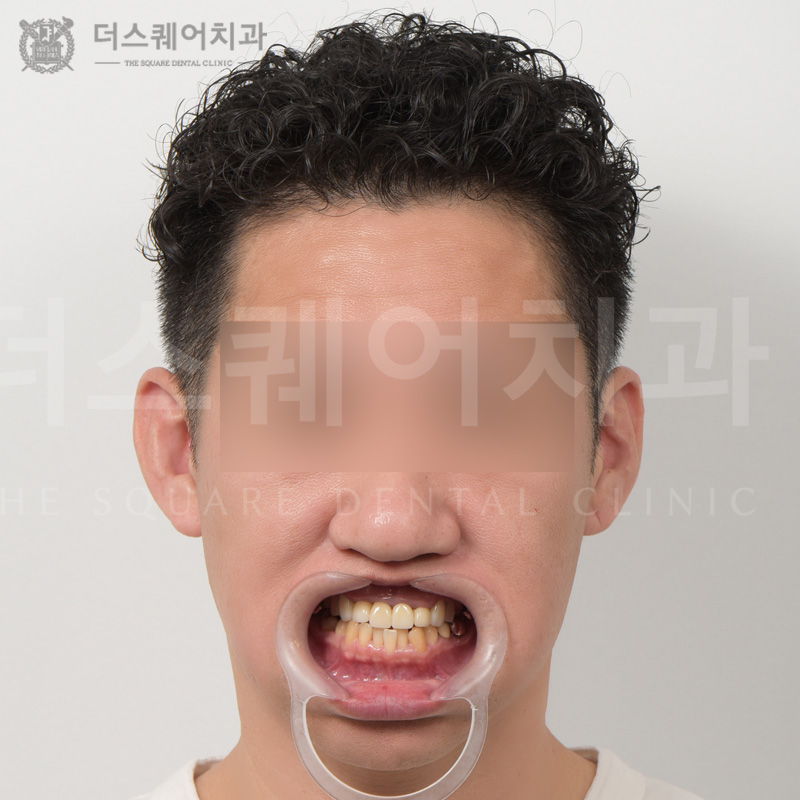 틀어진 치아 및 기존 보철 재치료를 위한 세라믹 크라운