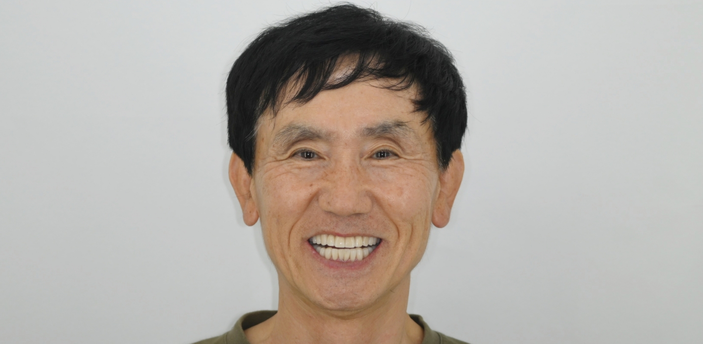 치아 파절 및 균열, 미니쉬로 치아복구