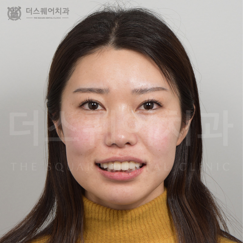 <br />
<b>Warning</b>:  Undefined variable $ba_title in <b>/home/thesquaredc.co.kr/jp/clinical-case/clinicalcase.php</b> on line <b>605</b><br />
