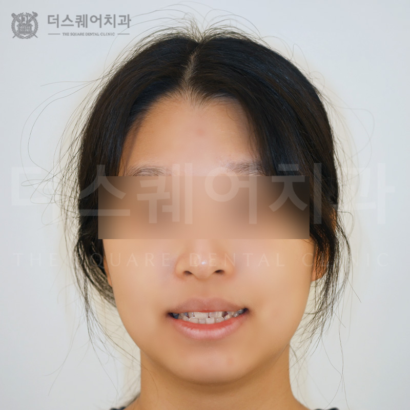 틀어진 치아, 개방교합으로 인한 치아교정(와이어)