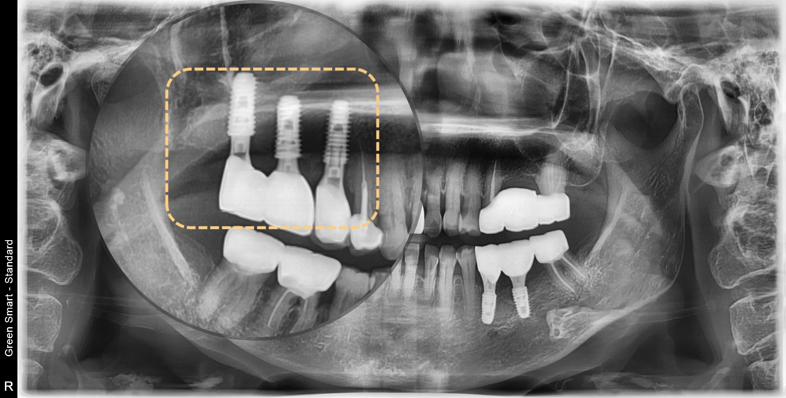 <br />
<b>Warning</b>:  Undefined variable $ba_title in <b>/home/thesquaredc.co.kr/jp/clinical-case/clinicalcase.php</b> on line <b>605</b><br />
