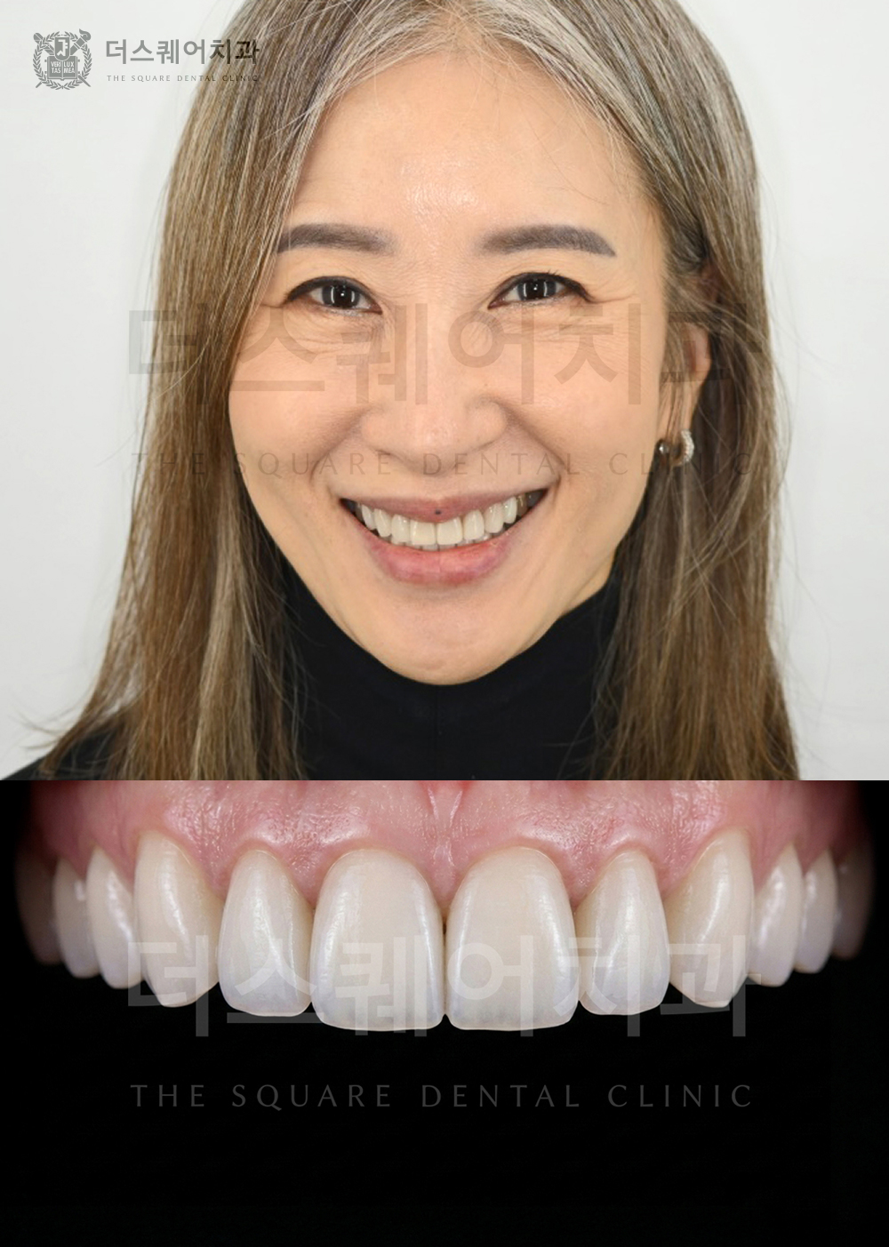 미니쉬로 치아노화를 해결한 케이스