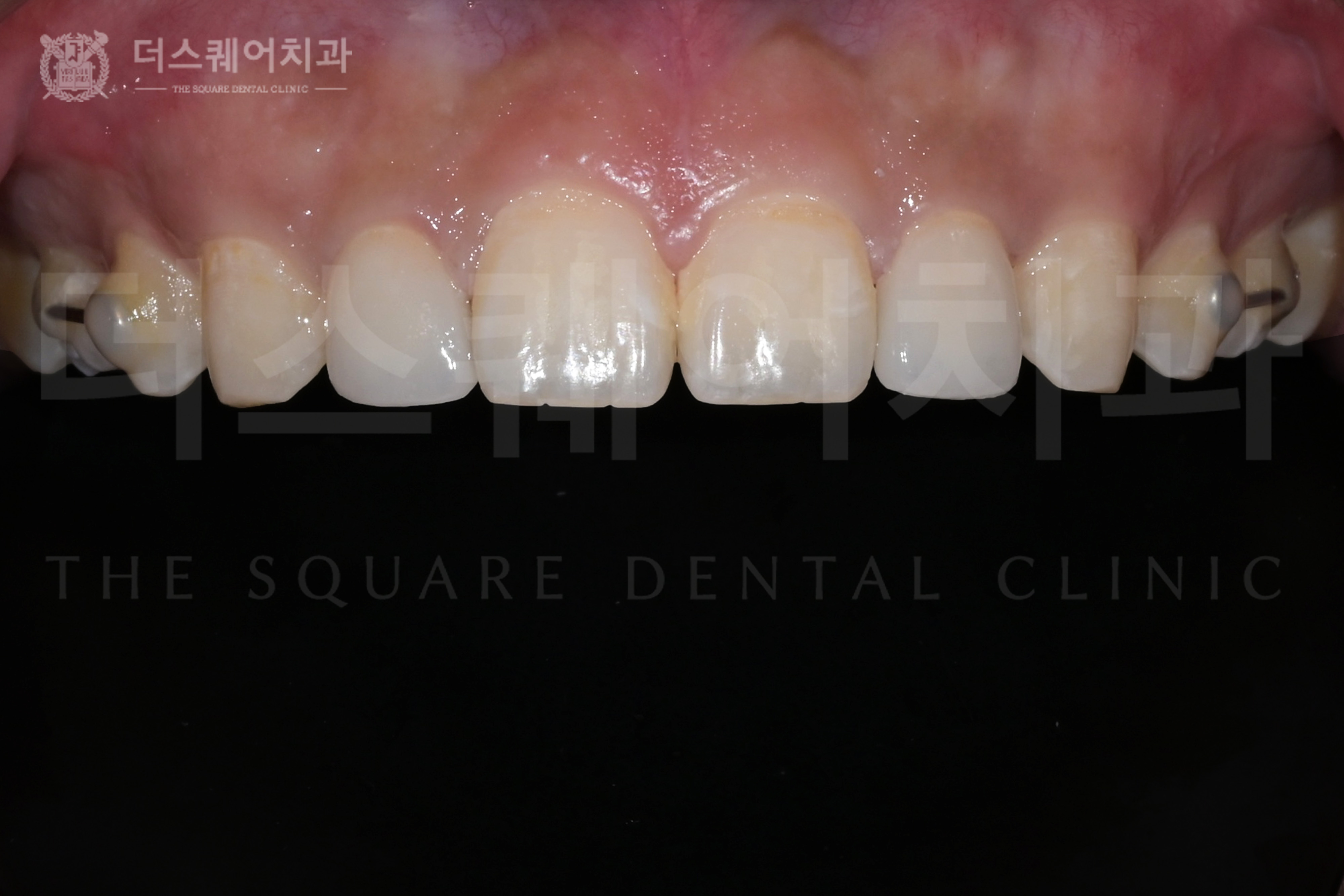 왜소치 · 손상된 앞니, 미니쉬 복구