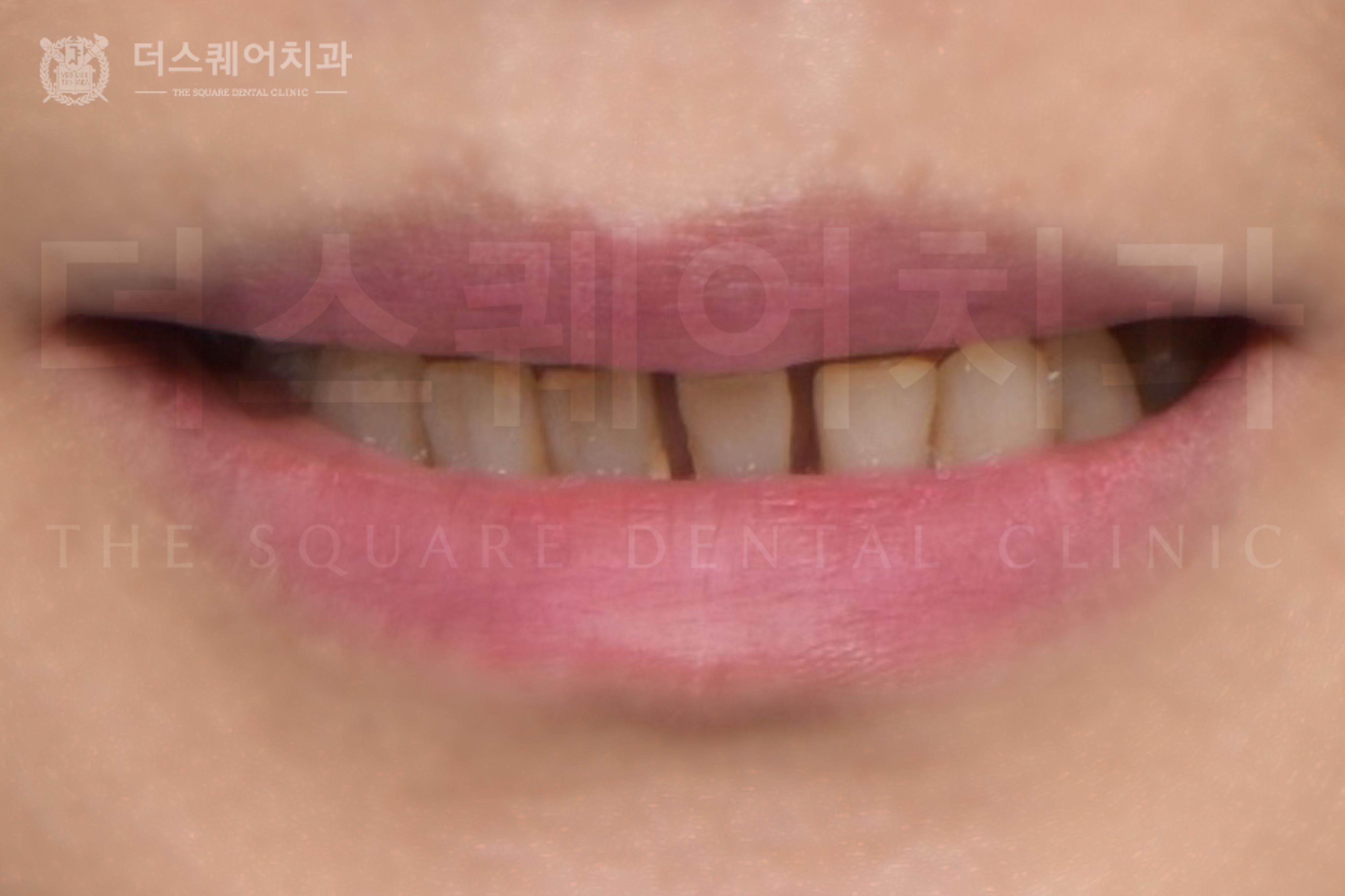 미니쉬, 치간이개 및 전치부 재치료