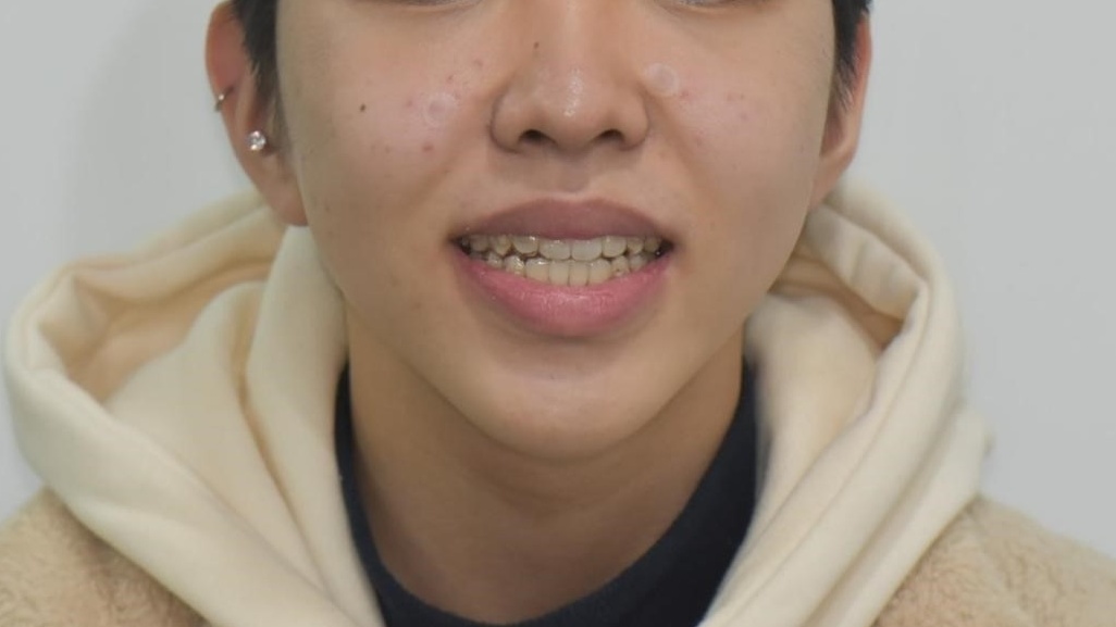 인비절라인
