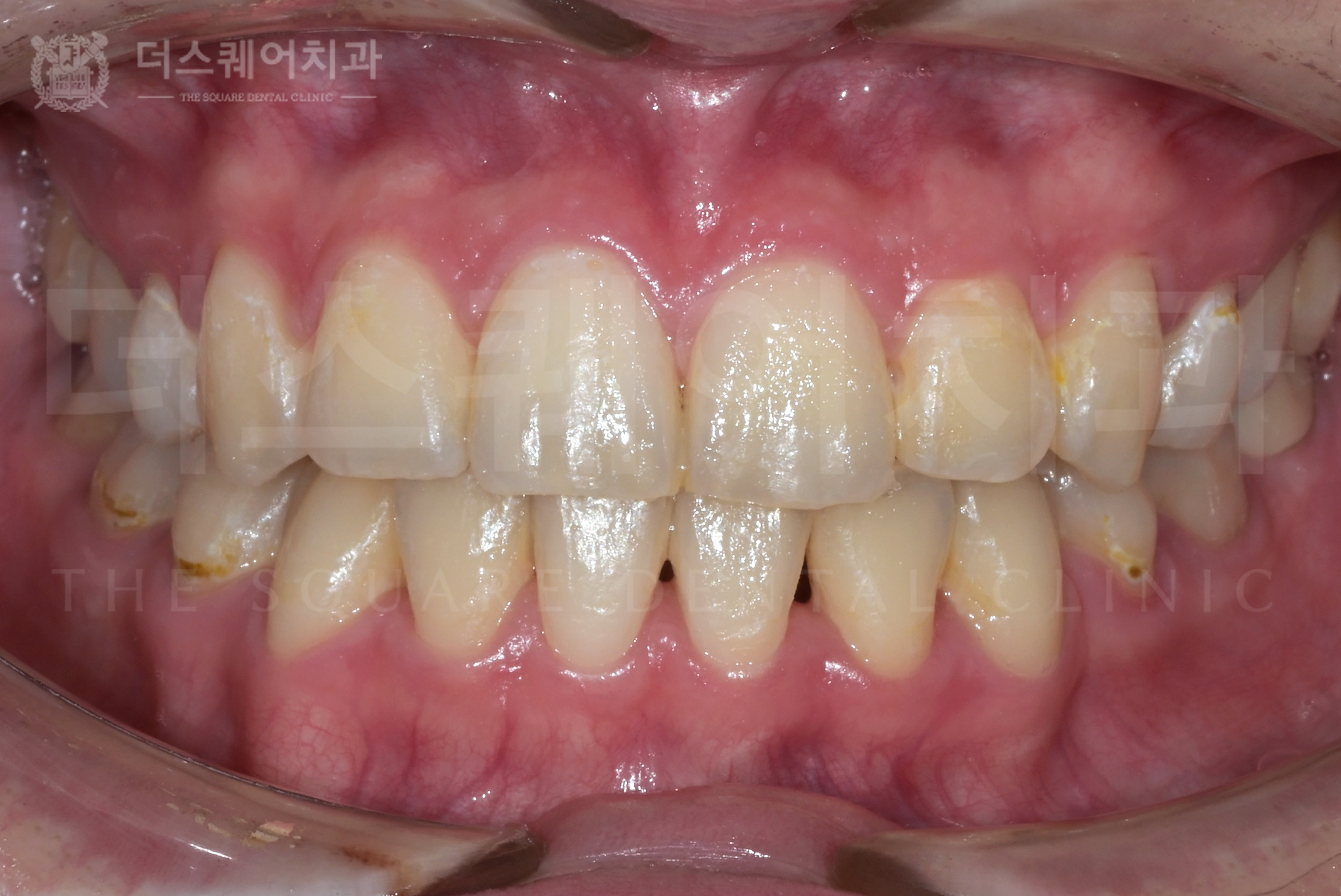 틀어진 치아, 비대칭, 부정교합 개선을 위한 치아교정(와이어)