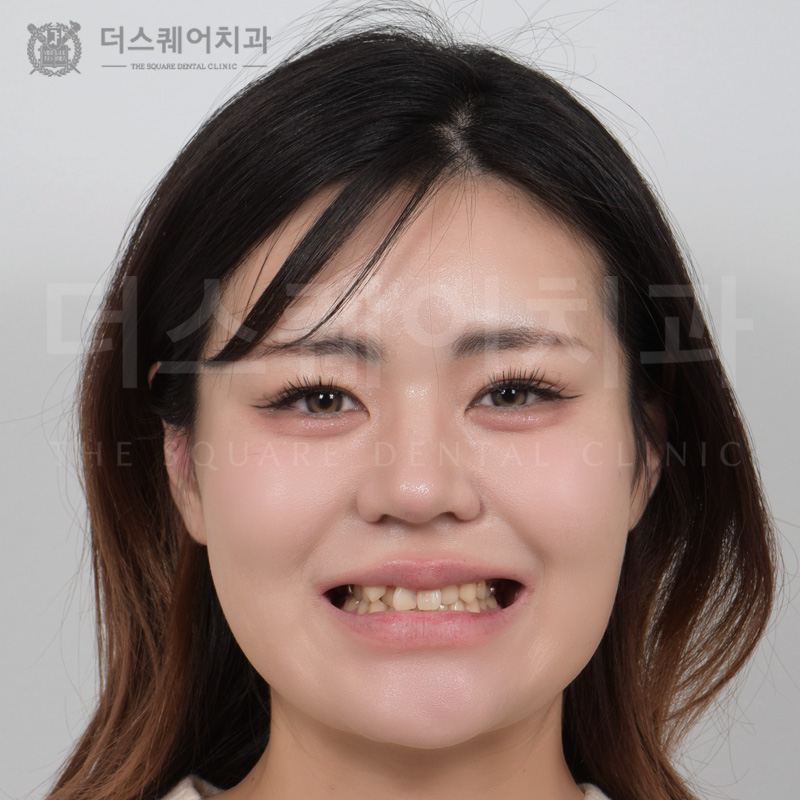 틀어진 치아, 부정교합, 덧니 개선을 위한 미니쉬 치아복구
