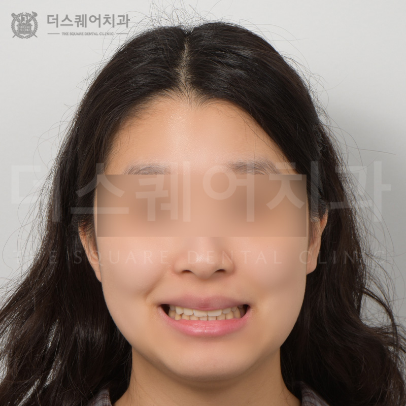 틀어진 치아, 개방교합으로 인한 치아교정(와이어)