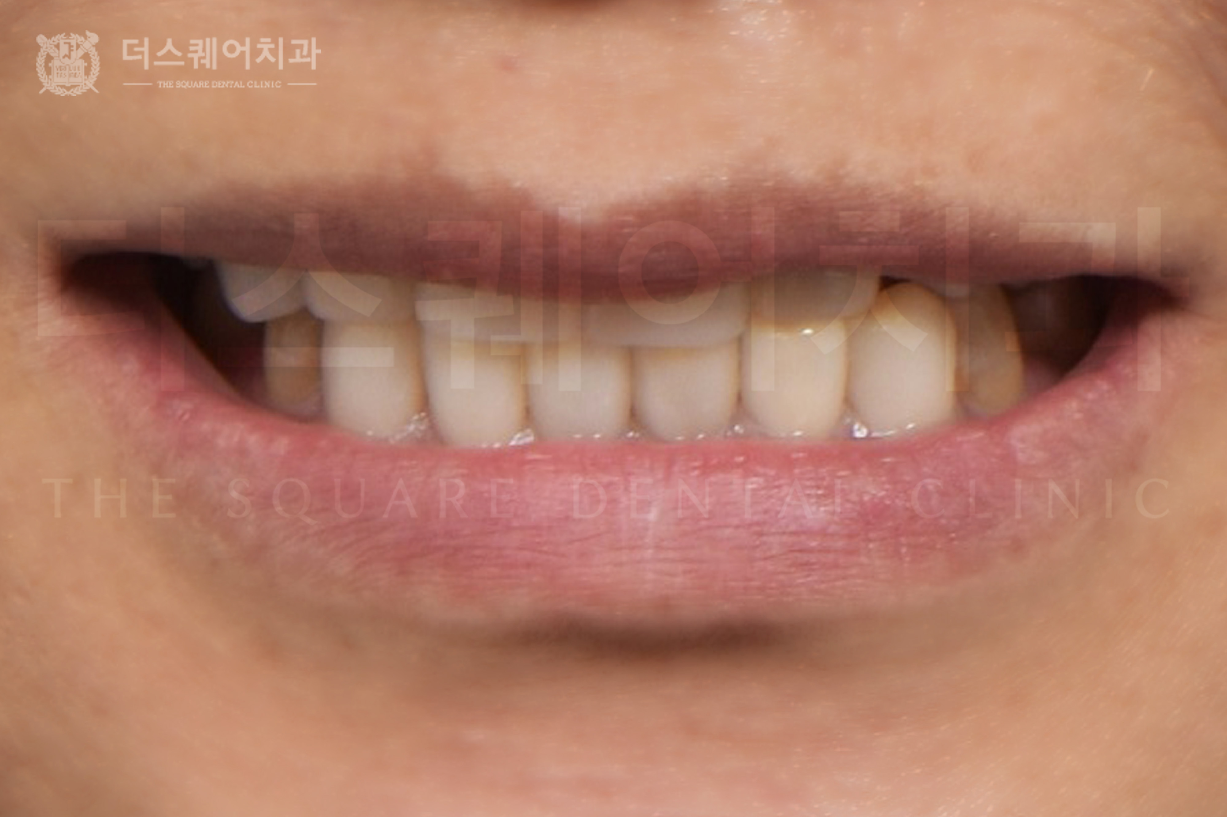미니쉬, 치간이개 및 전치부 재치료