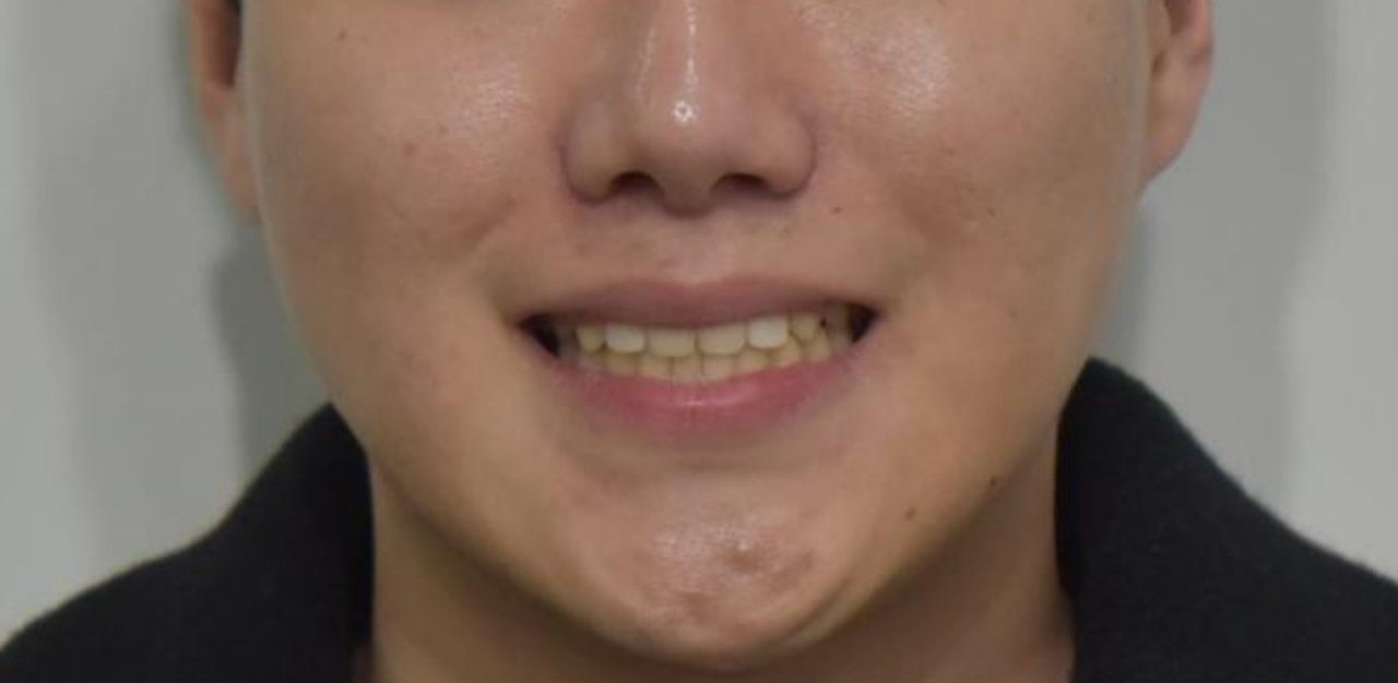 부정교합 및 덧니 브라켓 교정으로 가지런한 배열 해소
