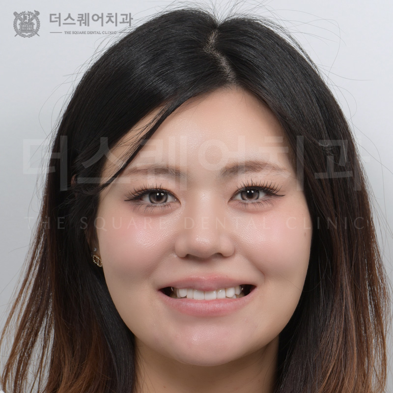 틀어진 치아, 부정교합, 덧니 개선을 위한 미니쉬 치아복구