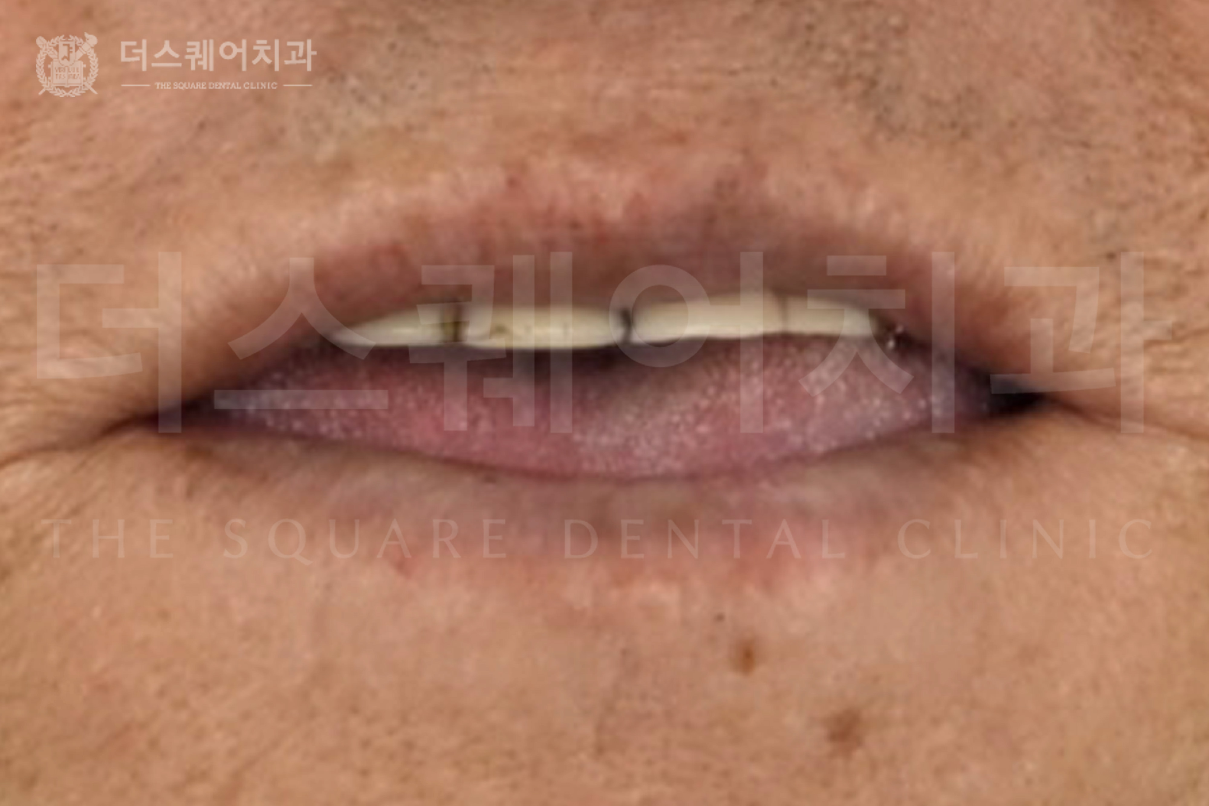 전체 임플란트로 회복한 구강 기능 개선